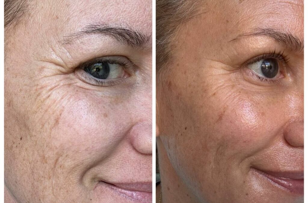 Een betere huid willen, maar geen internal nemen?